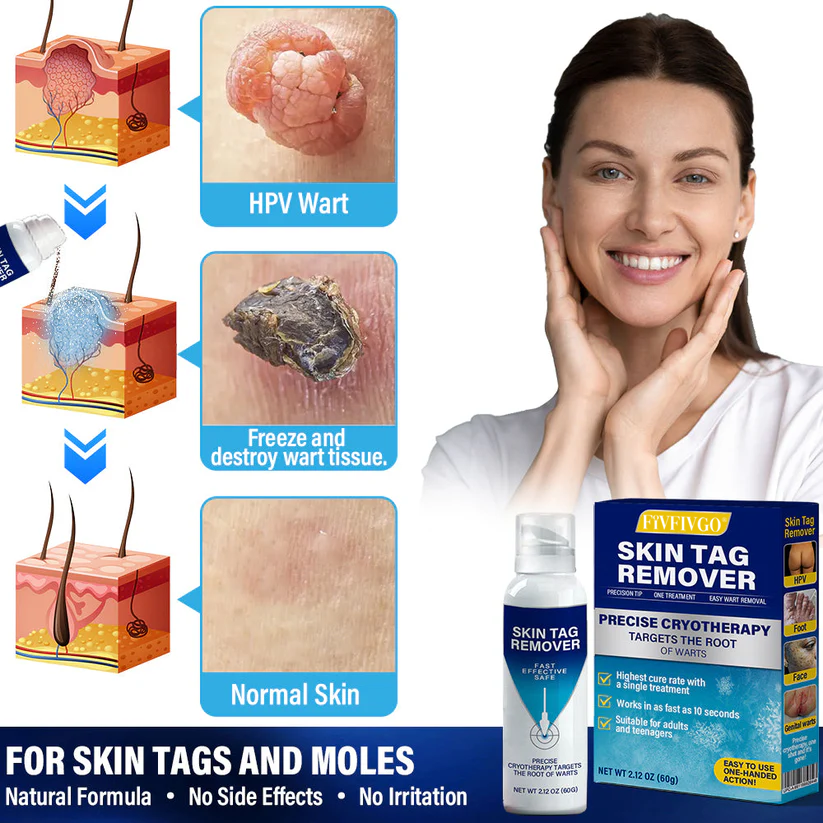 Fivfivgo at-home cryotherapy spray for skin tags and warts