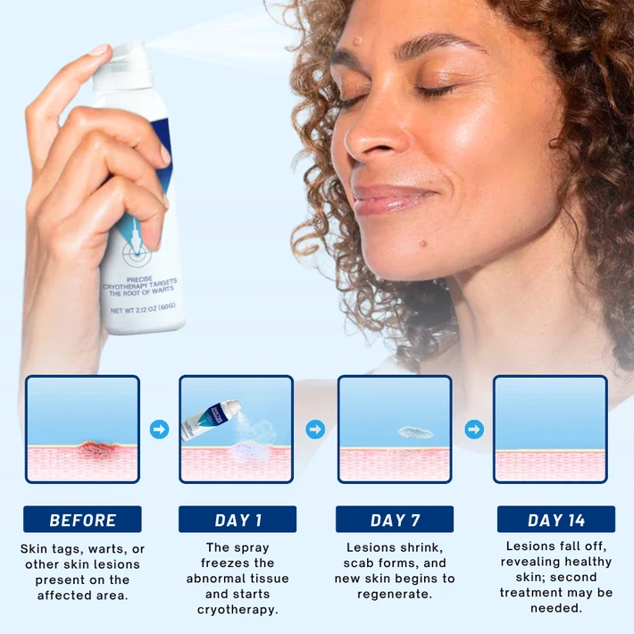 Fivfivgo cryo treatment spray for targeted wart care