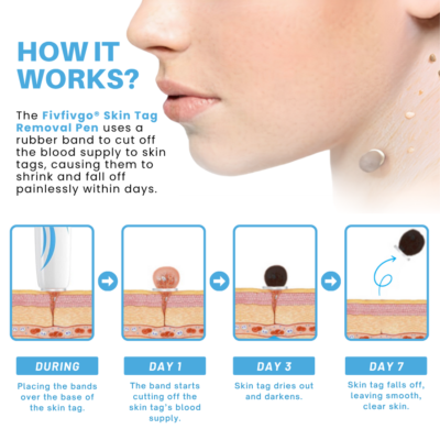 Fivfivgo ligation pen for targeted skin tag removal