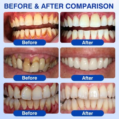 BBOJI® GumRevive formula with enamel matrix derivative EMD